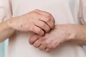 Klinik Purama - alergi